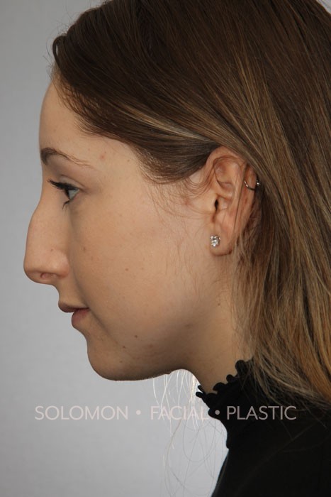 Rhinoplasty Surgery Before After Photos