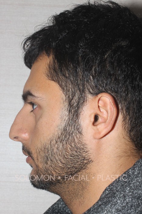 Rhinoplasty Surgery Before After Photos