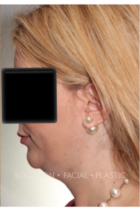 Neck Liposuction Before & After