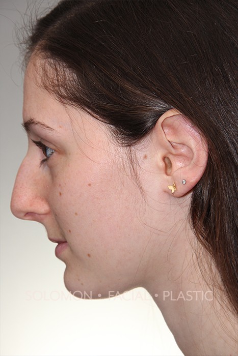 Rhinoplasty Surgery Before After Photos