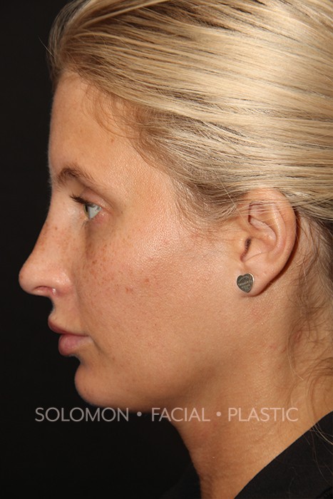 Rhinoplasty Surgery Before After Photos