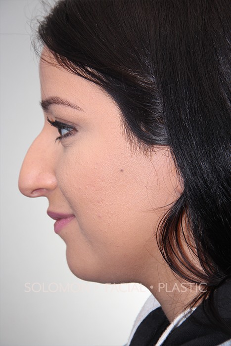 Rhinoplasty Surgery Before After Photos