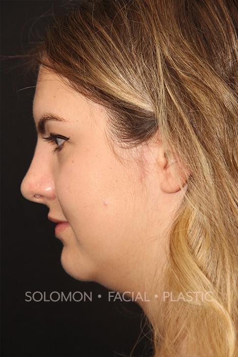 Rhinoplasty Surgery Before After Photos