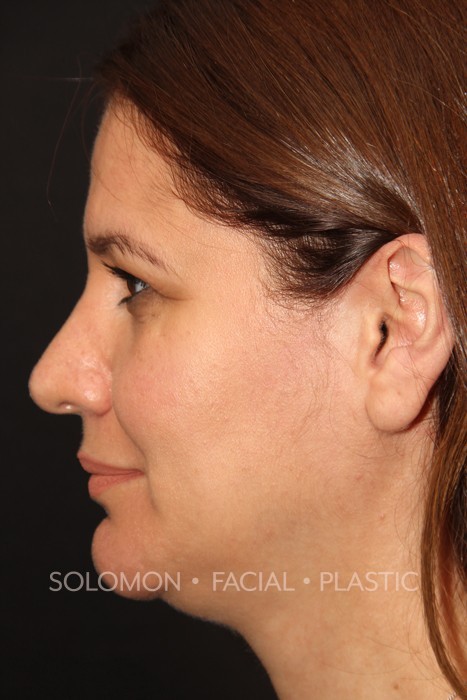 Rhinoplasty Toronto Before & After Photos