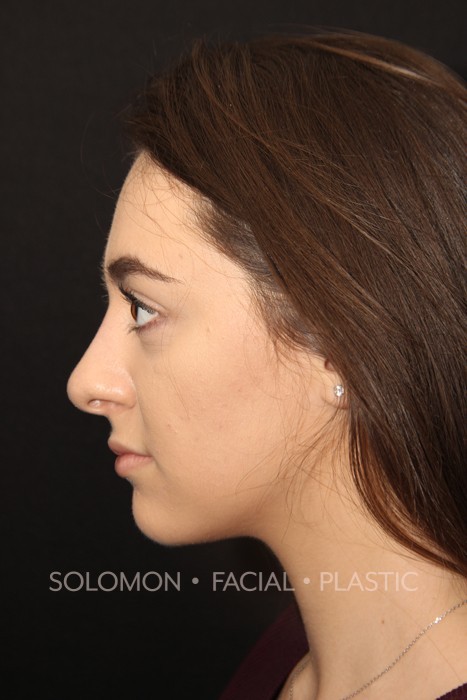 Rhinoplasty Surgery Before After Photos