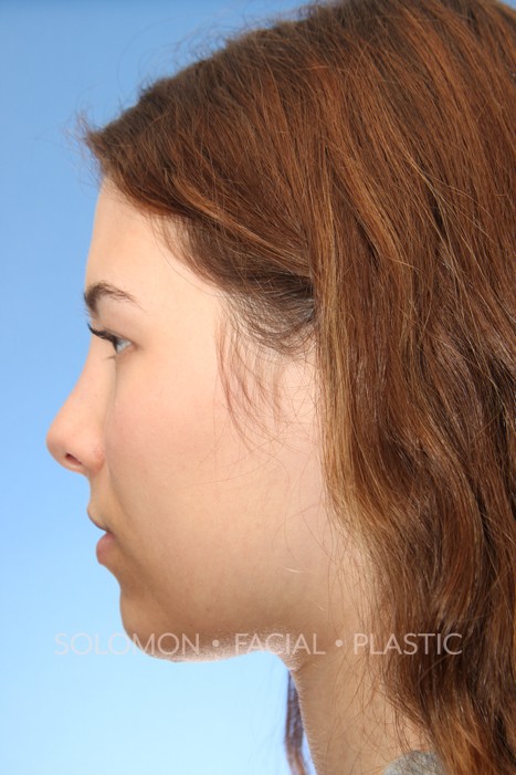 Rhinoplasty Surgery Before After Photos