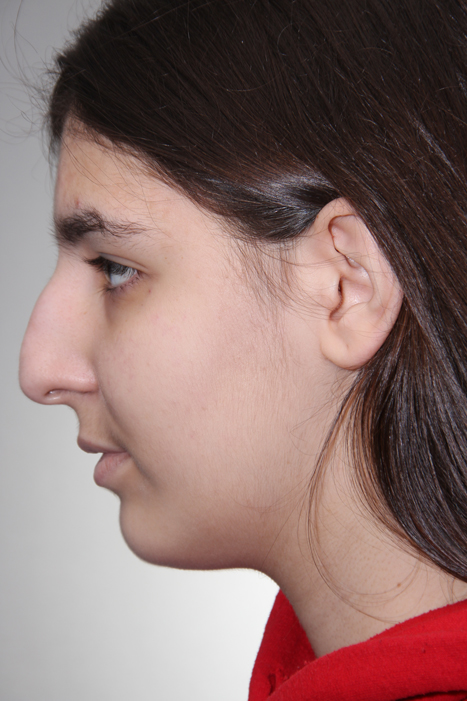 Rhinoplasty Surgery Before After Photos