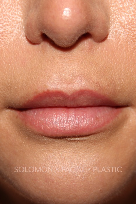 Lip Lift Before After Photos