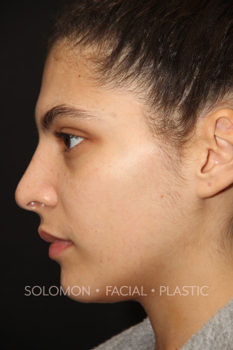 Rhinoplasty Surgery Before After Photos