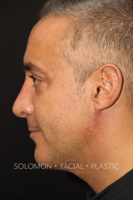 Chin Implant Before After Photos