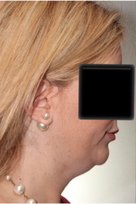 Facetite  Dr. Solomon - Cosmetic Facial Surgery  Toronto