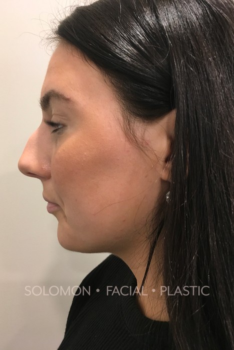 This 21 year old young woman was treated with 1.5 ml of dermal filler to give the appearance of a straightened nasal bridge as she had a deficit in the upper portion of her bridge.