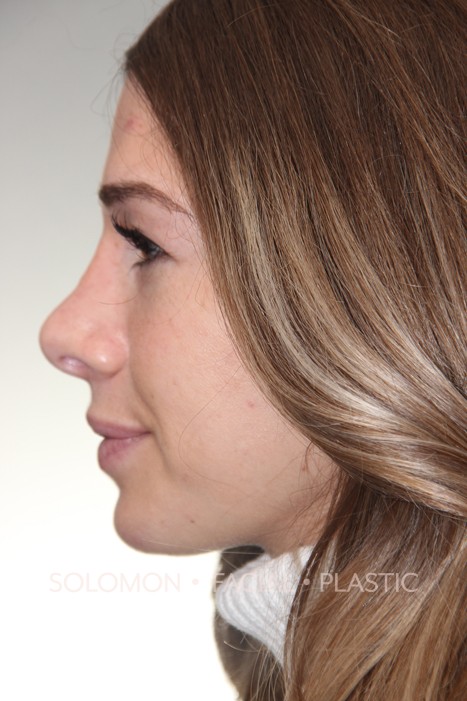 Revision Rhinoplasty Toronto Before After Photos