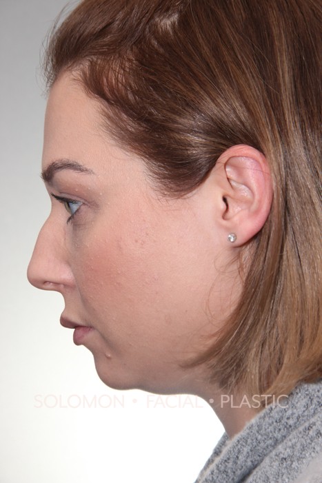 Rhinoplasty Surgery Before After Photos