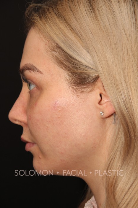 Chin Implant Before After Photos