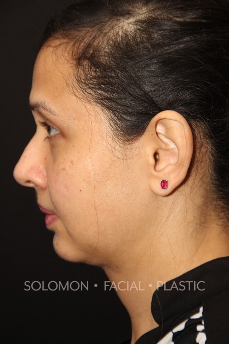 Neck Liposuction Before & After