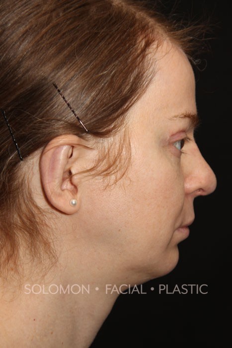 Otoplasty Before After Photos