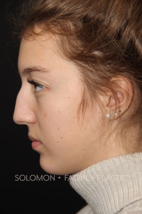 Rhinoplasty Surgery Before After Photos