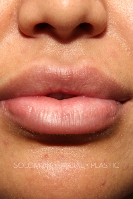 Lip Reduction Before After Photos