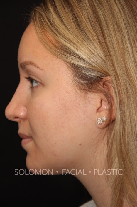 Rhinoplasty Before After Photos