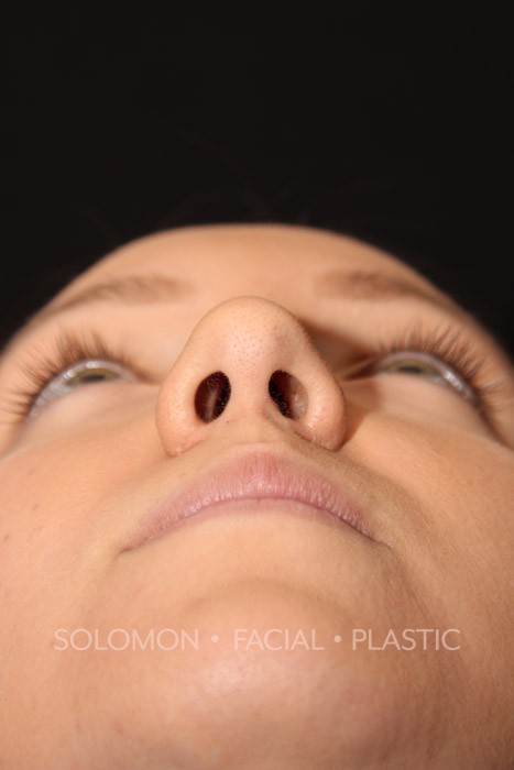 Rhinoplasty Before After Photos