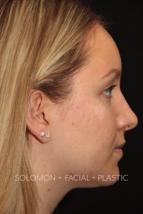 Rhinoplasty Before After Photos