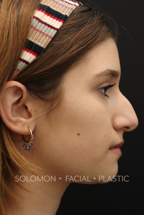 Rhinoplasty Before After Photo
