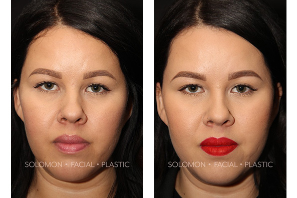 Buccal Fat Extraction Before and After