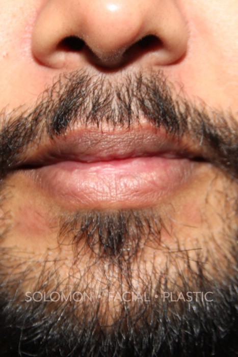 Lip Reduction Before After Photos