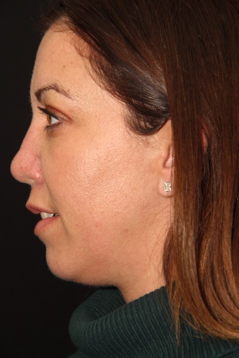 Rhinoplasty Toronto Before & After Photos