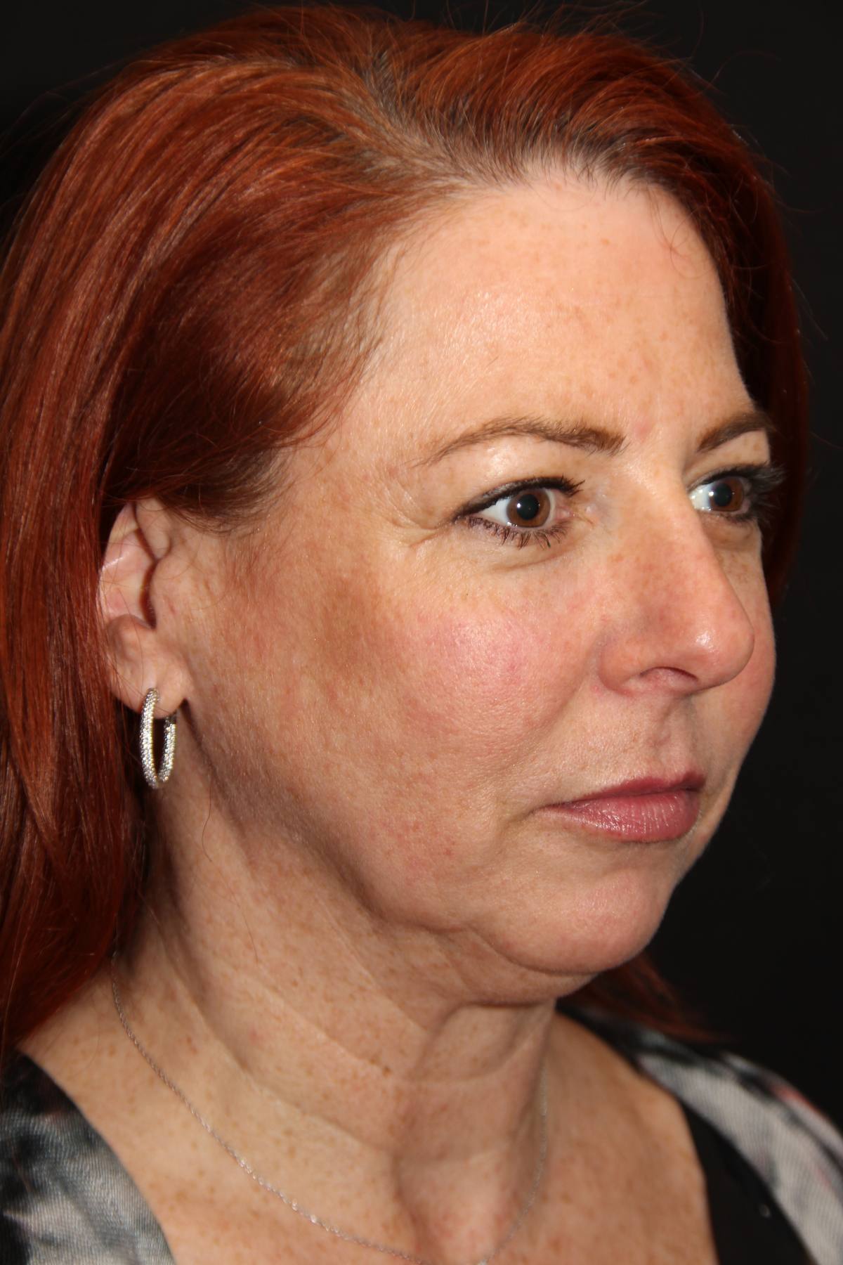 Facelift Before After Photos