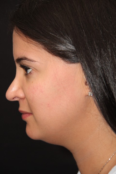 Revision Rhinoplasty Toronto Before After Photos