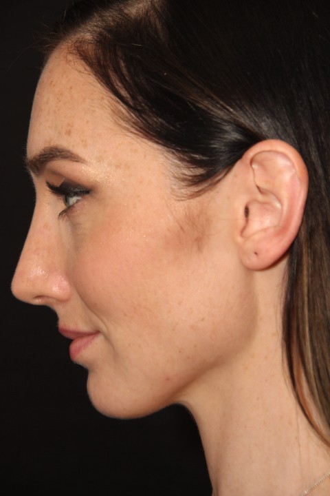 Rhinoplasty Toronto Before & After Photos