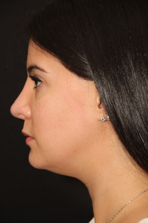 Revision Rhinoplasty Toronto Before After Photos