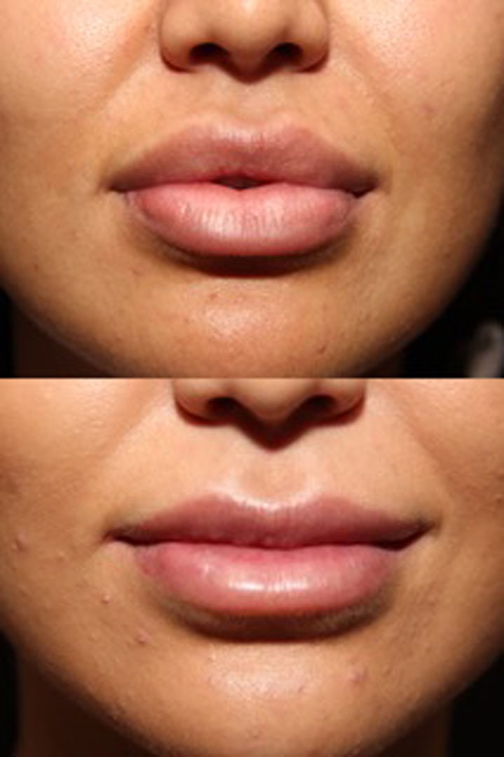 Lip Reduction Surgery Toronto Before After Dr. Philip Solomon Best Lip Reduction Surgery Before After Dr Philip Solomon