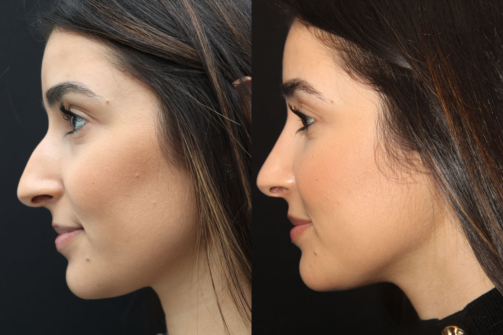 Rhinoplasty before and after