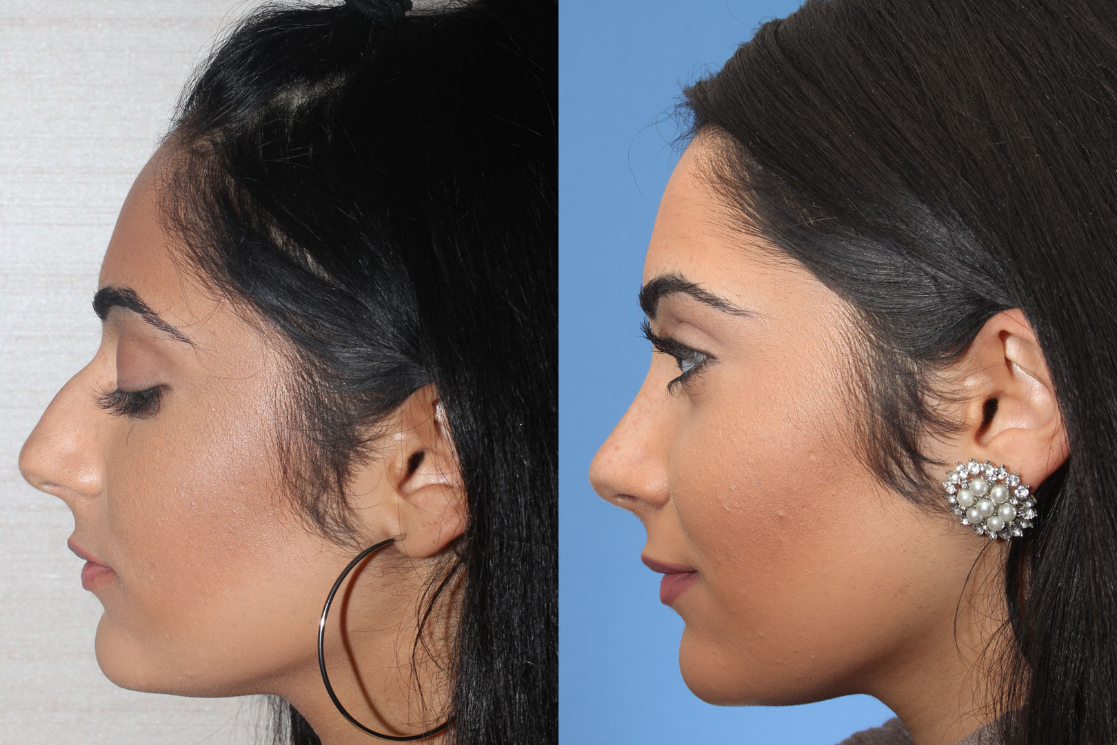 Rhinoplasty Toronto before and after results