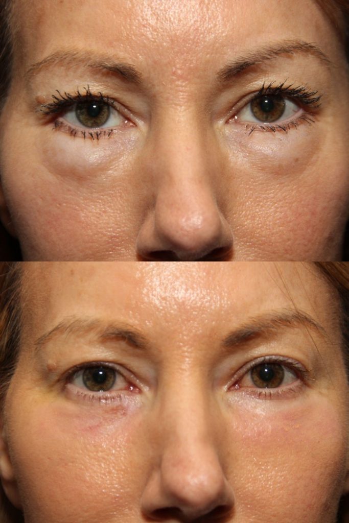 Blepharoplasty eyelid surgery before and after
