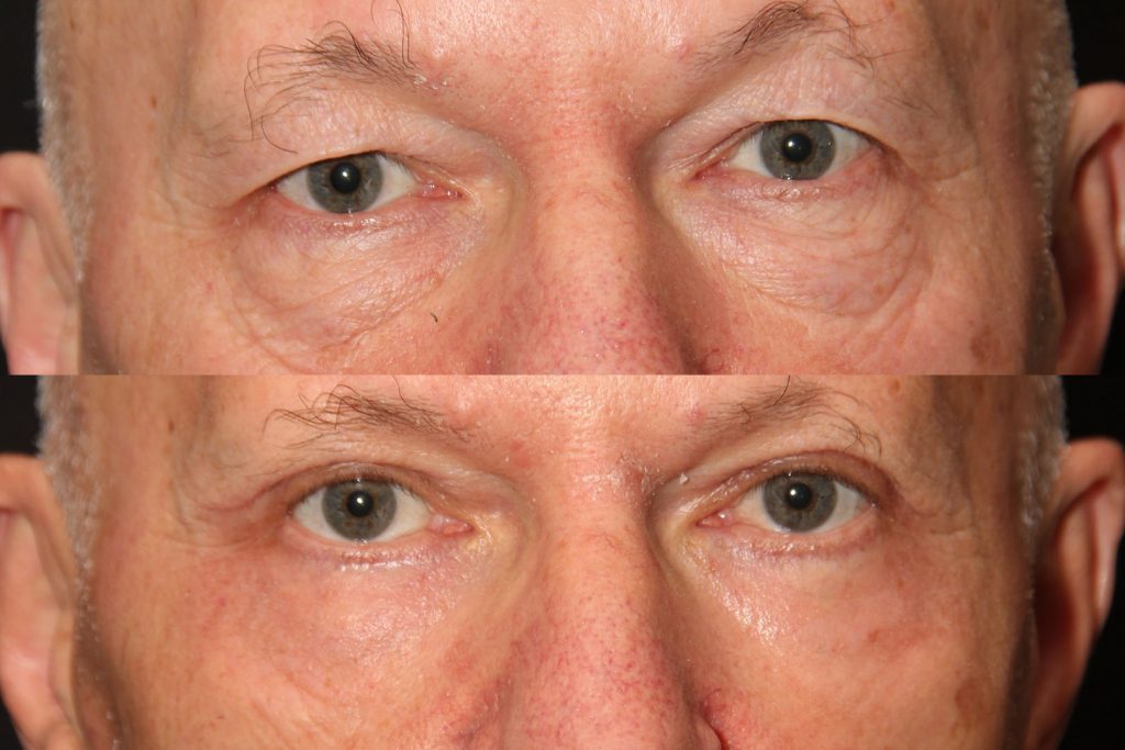 Blepharoplasty surgery before and after