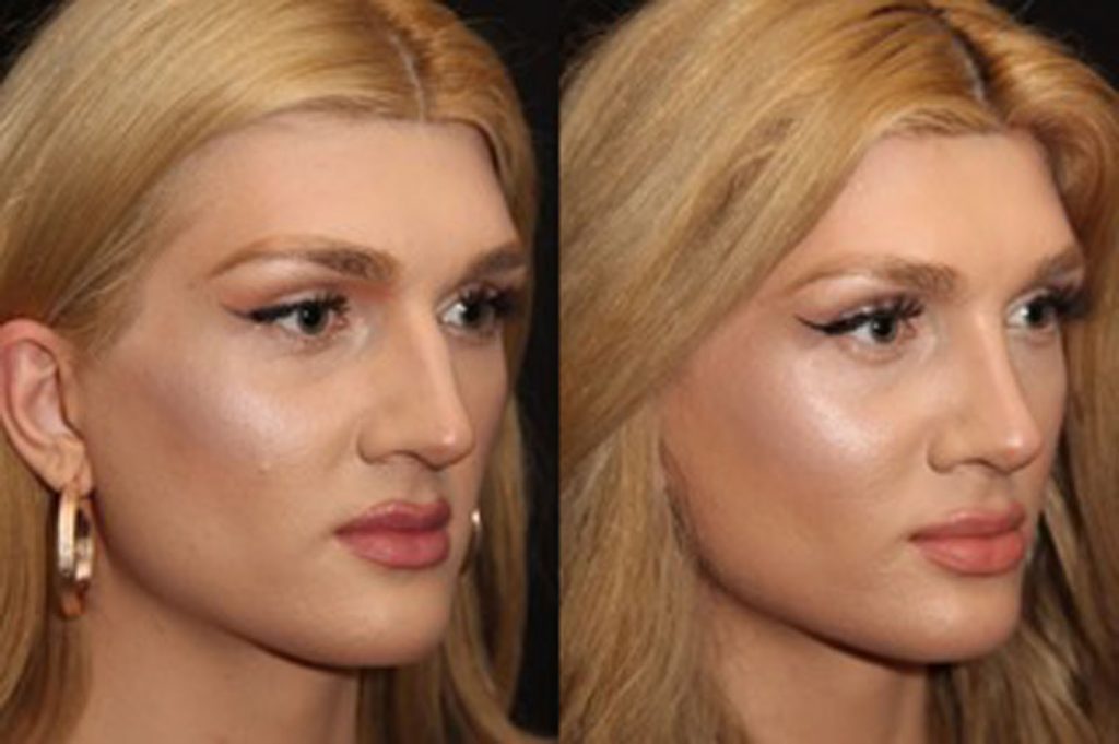 Facial Feminization Surgery before and after Toronto 3
