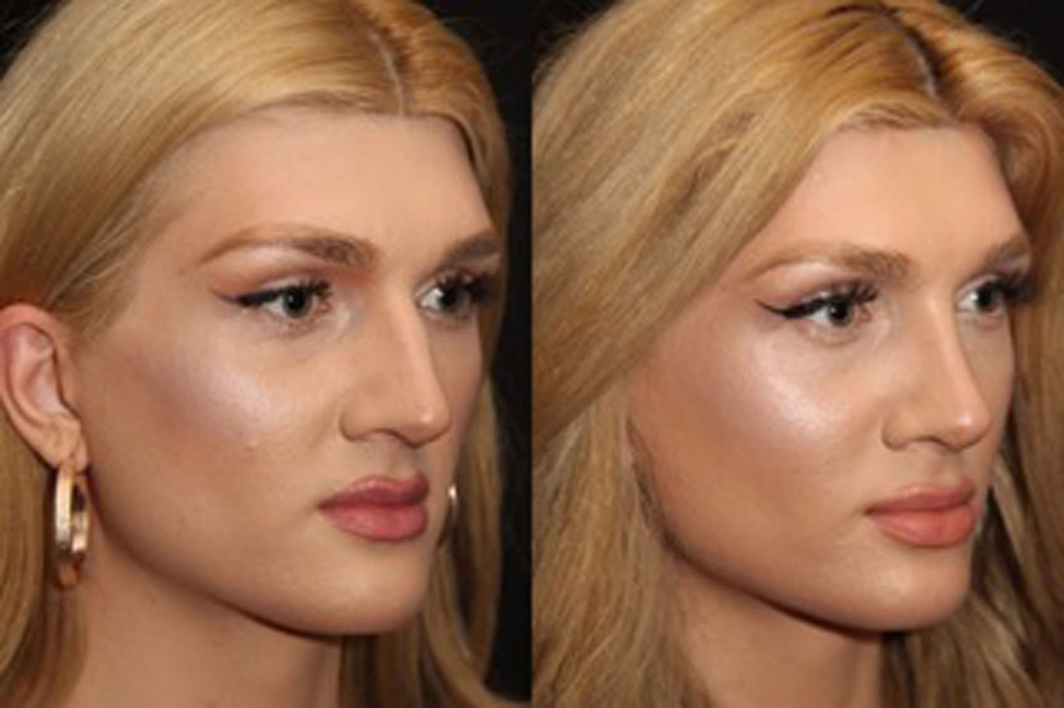Transsexual facial feminization sugery Transsexual facial feminization sugery