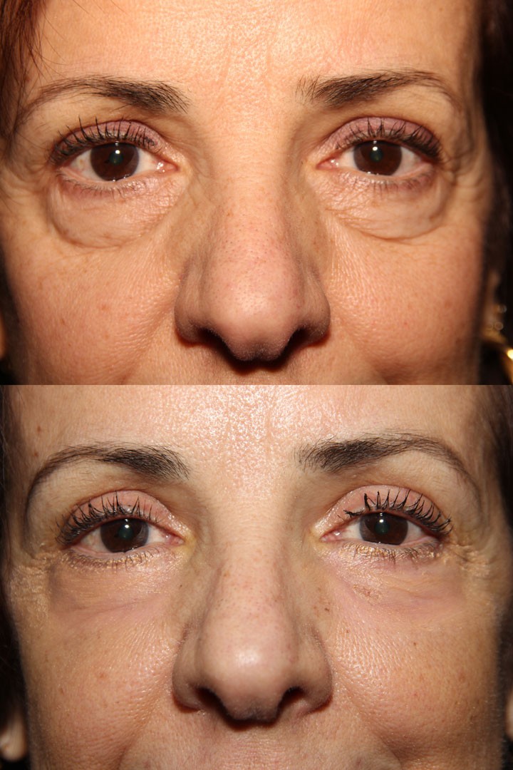 eyelid surgery toronto