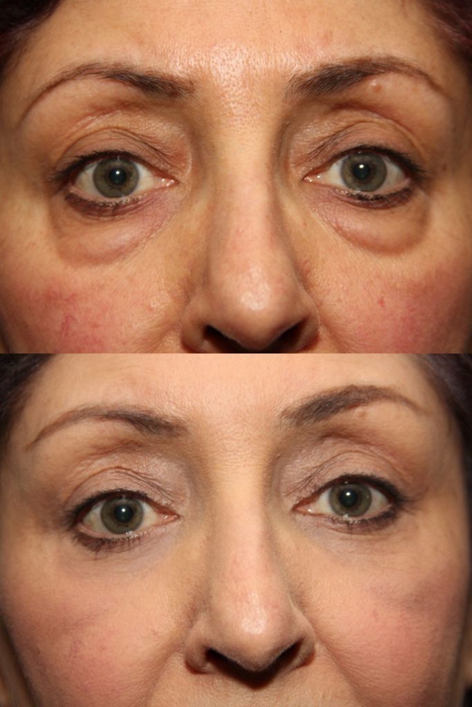 Eyelid surgery before and after