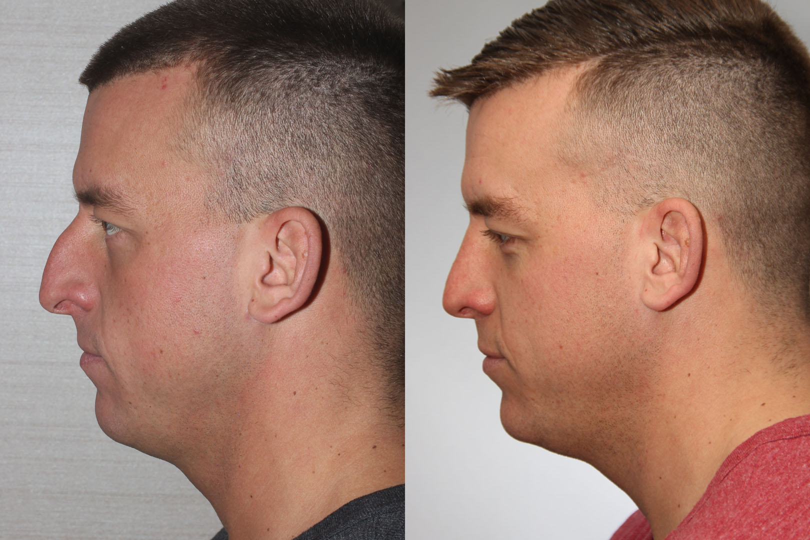 Rhinoplasty surgery before and after 
