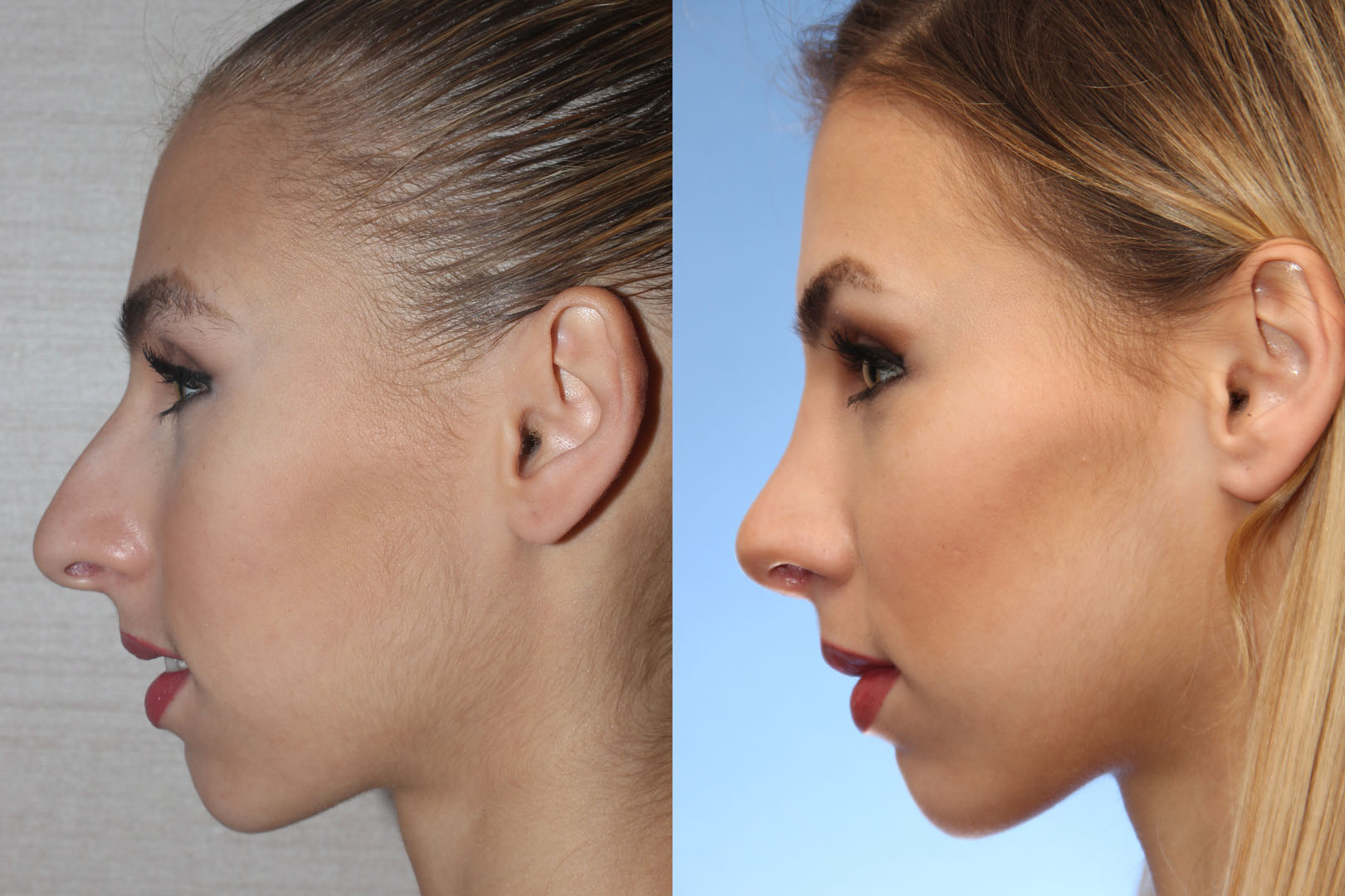 Rhinoplasty surgery before and after result