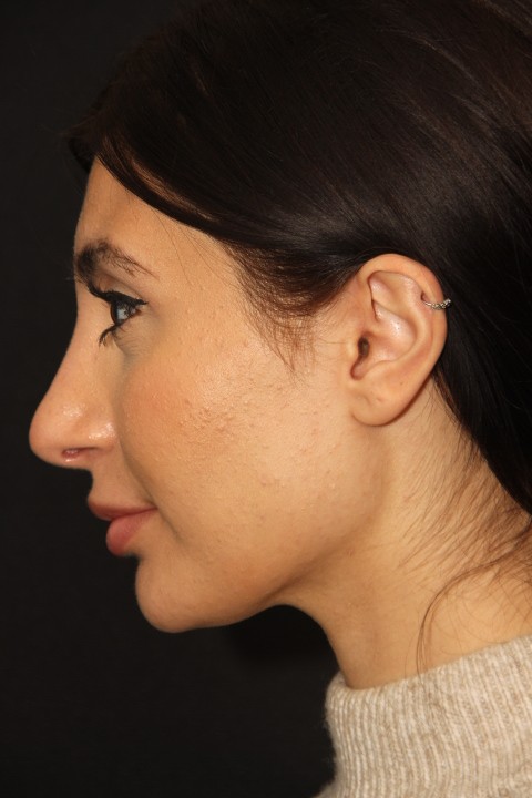 Female Closed Rhinoplasty After