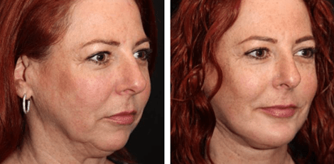 Deep Plane Facelift before and after Toronto 1