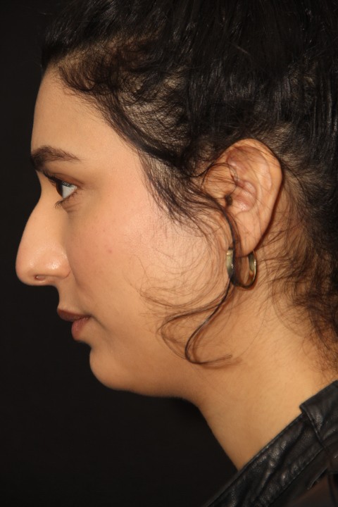 Cosmetic Rhinoplasty Surgery Picture Before