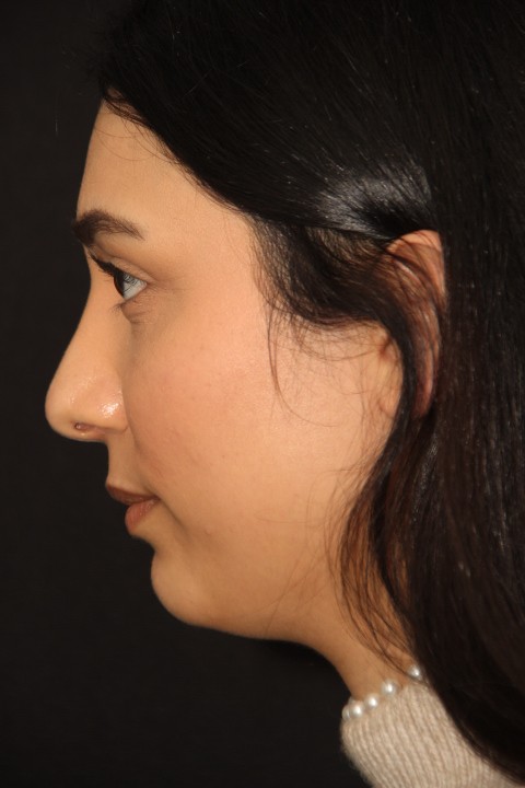 Persian Rhinoplasty Patient Before