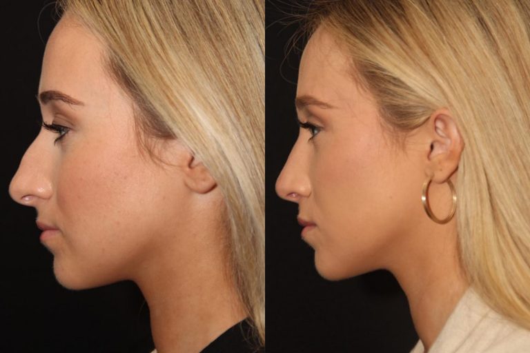 Rhinoplasty Surgery in Toronto Solomon Facial Plastic